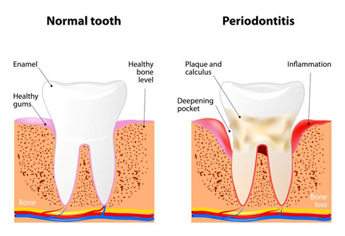 Periodontal Treatments Must Not Kill The Oral Microbiome
