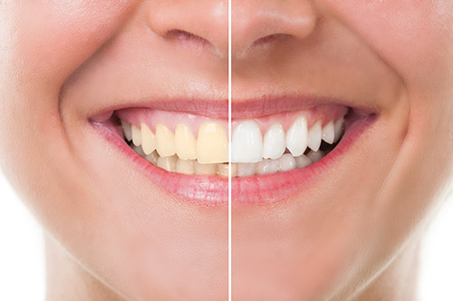 Professional Teeth Whitening Soldotna AK