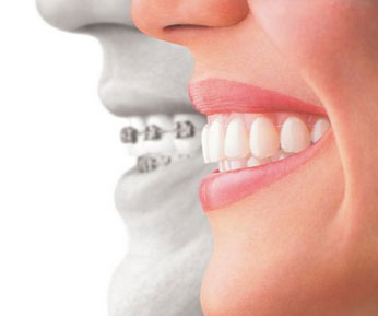 Invisalign Orthodontics Soldotna, AK