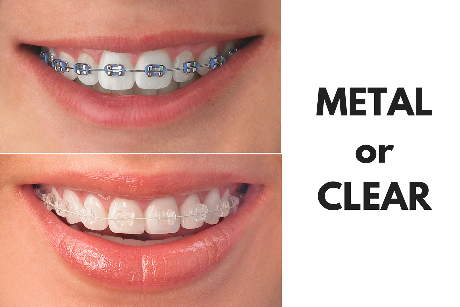 Ask Your Soldotna Dentist: Should I Get Metal or Clear Braces?